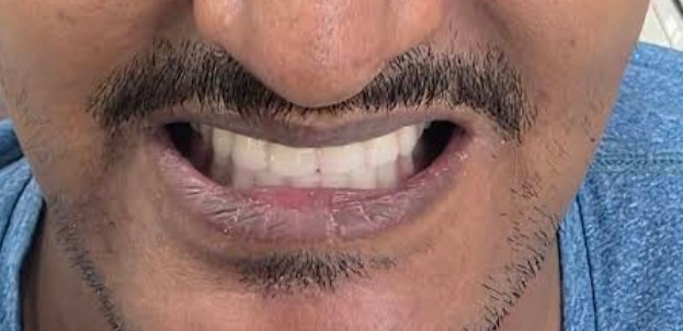 Implant restoration after treatment