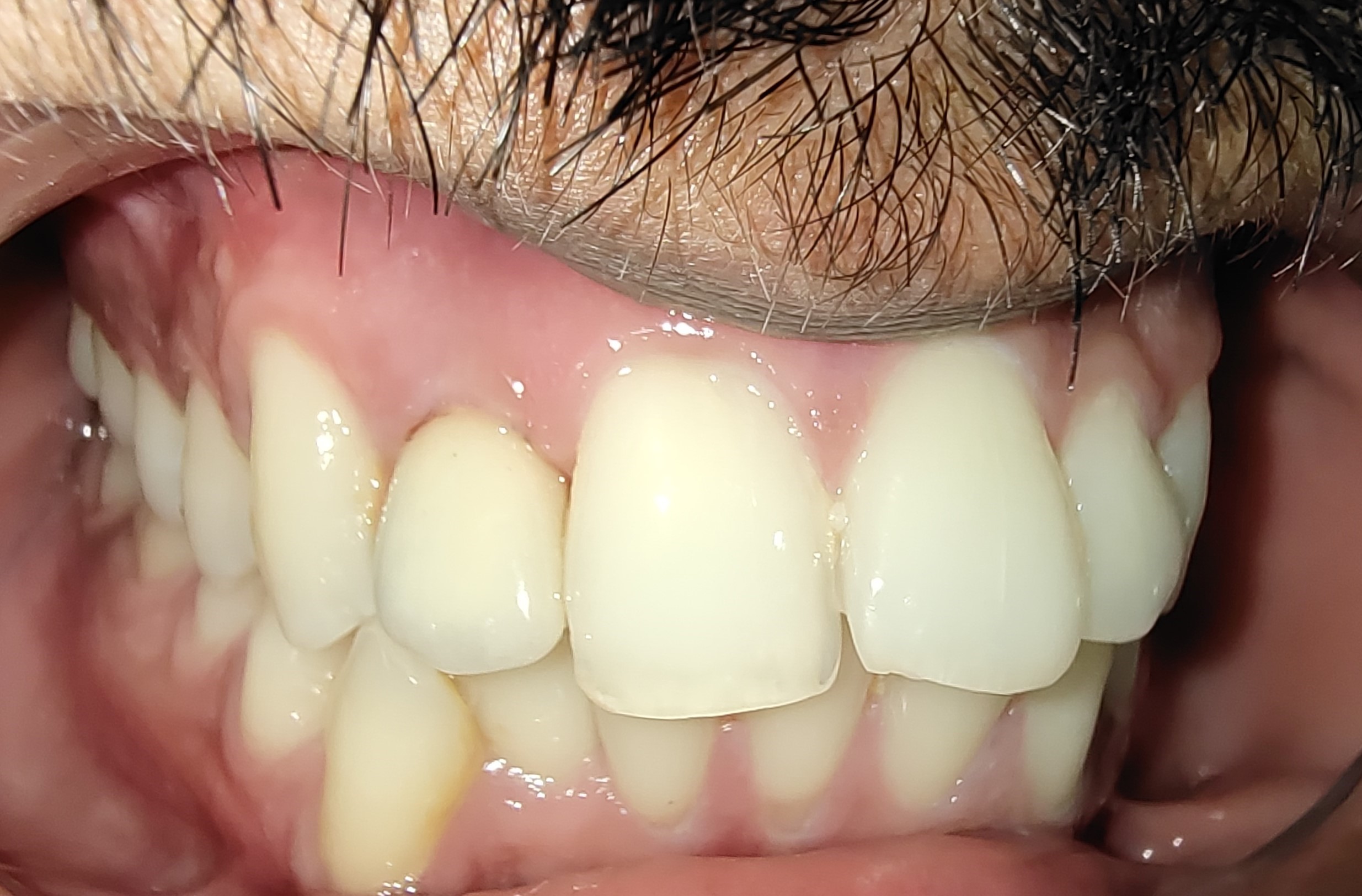 Cosmetic improvement after treatment
